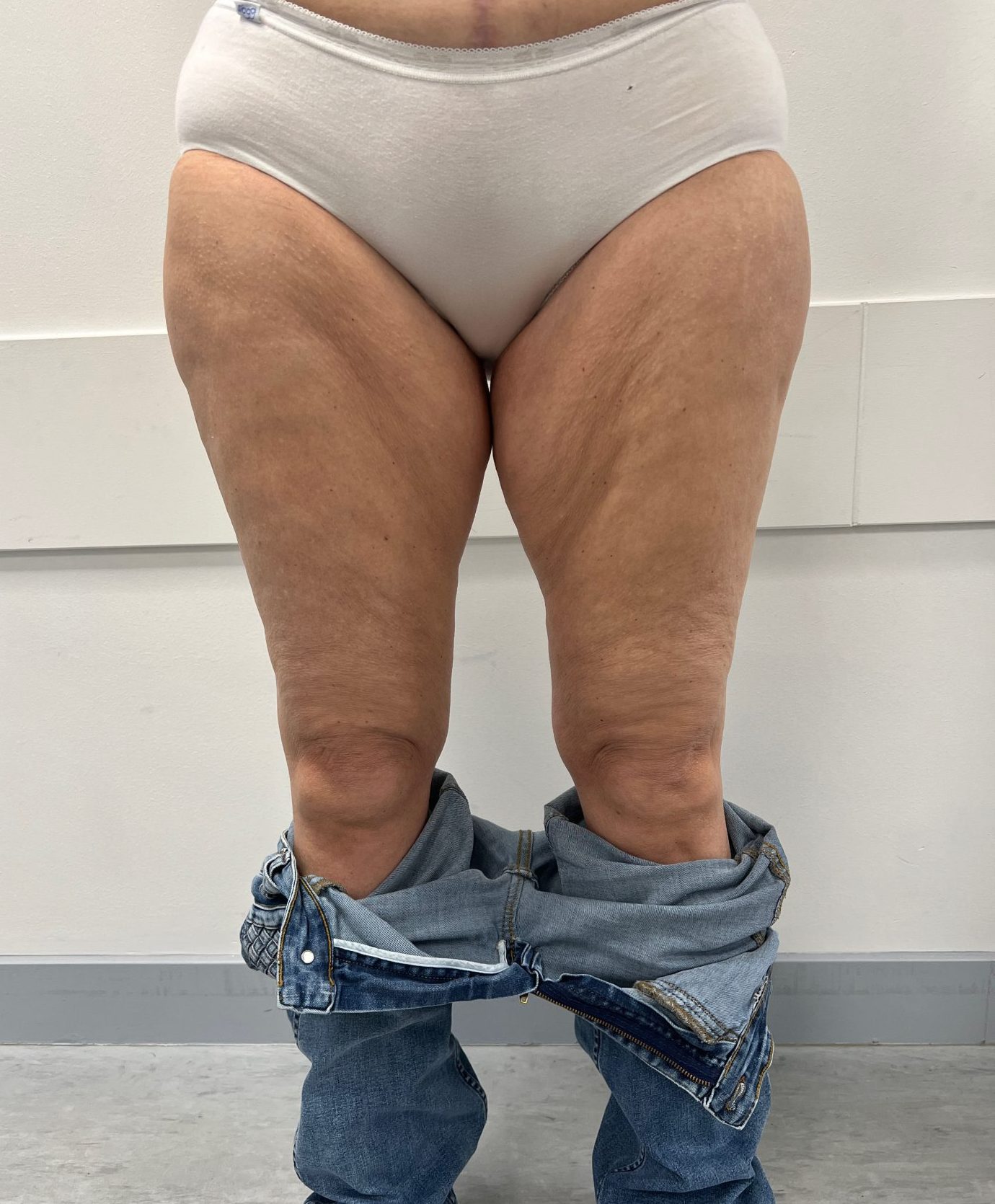 Thigh lift before