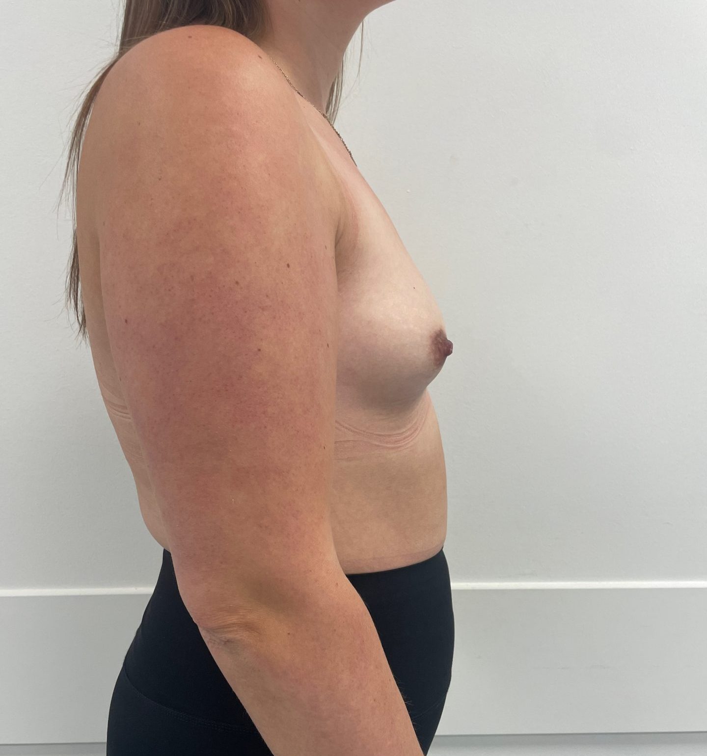 Breast augmentation before