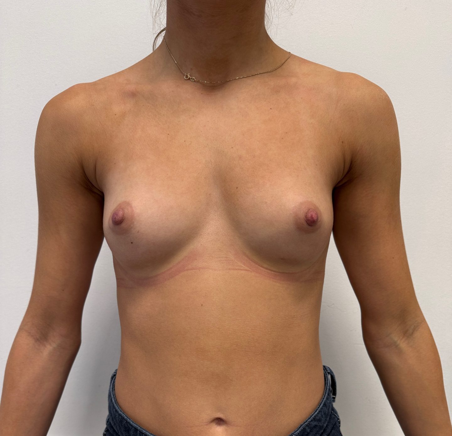 Breast augmentation before