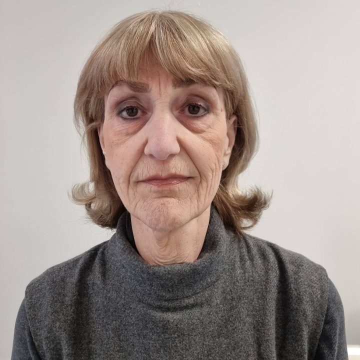 Neck facelift before