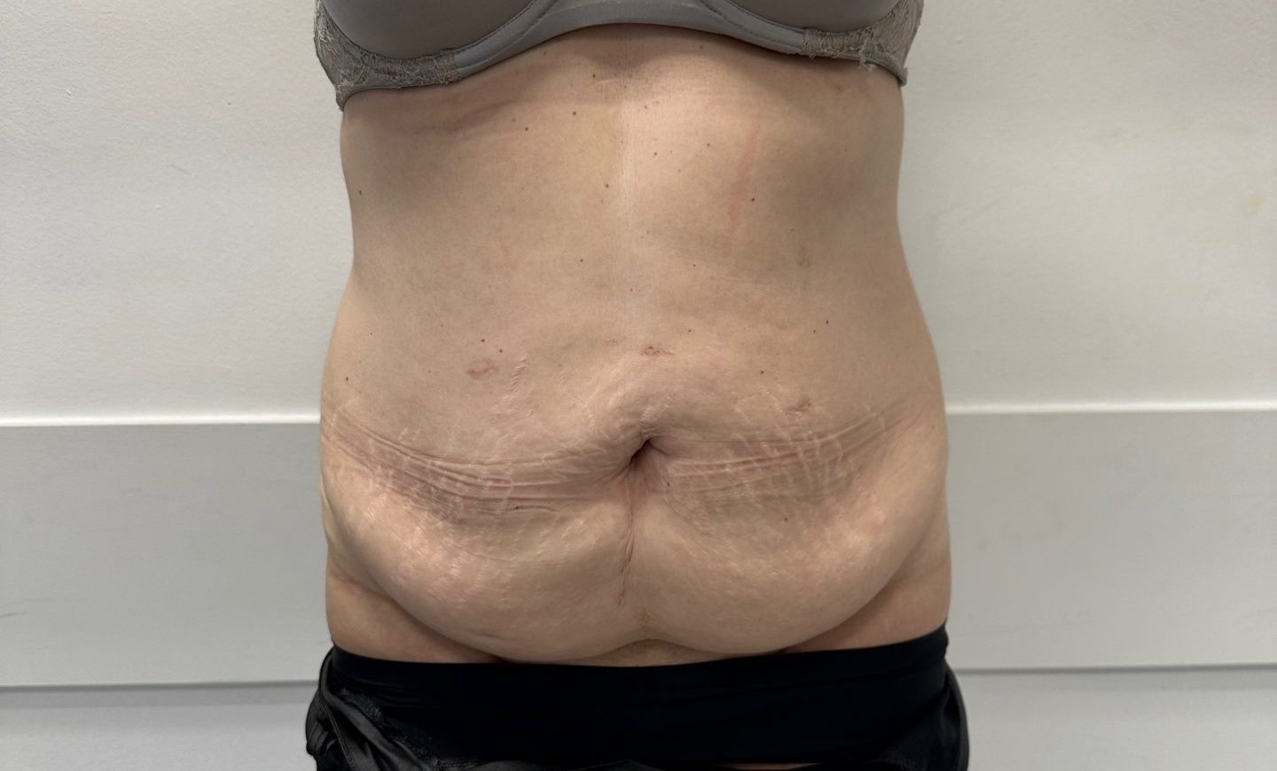 Tummy tuck before