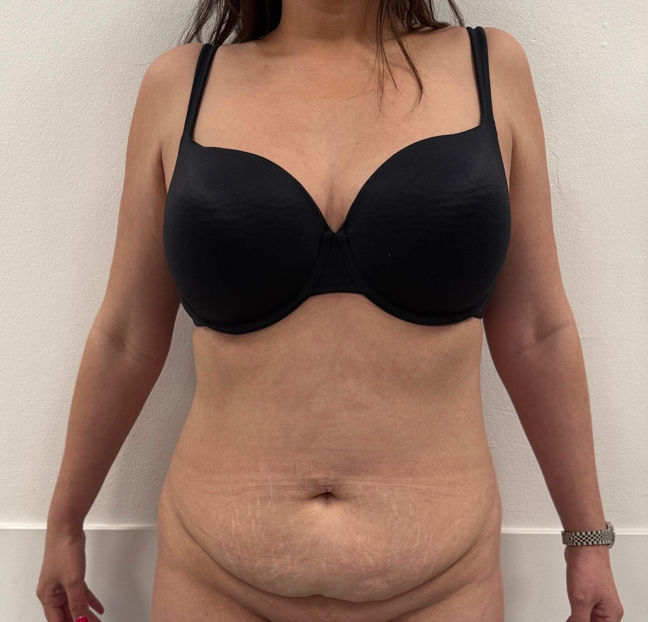 Tummy tuck before