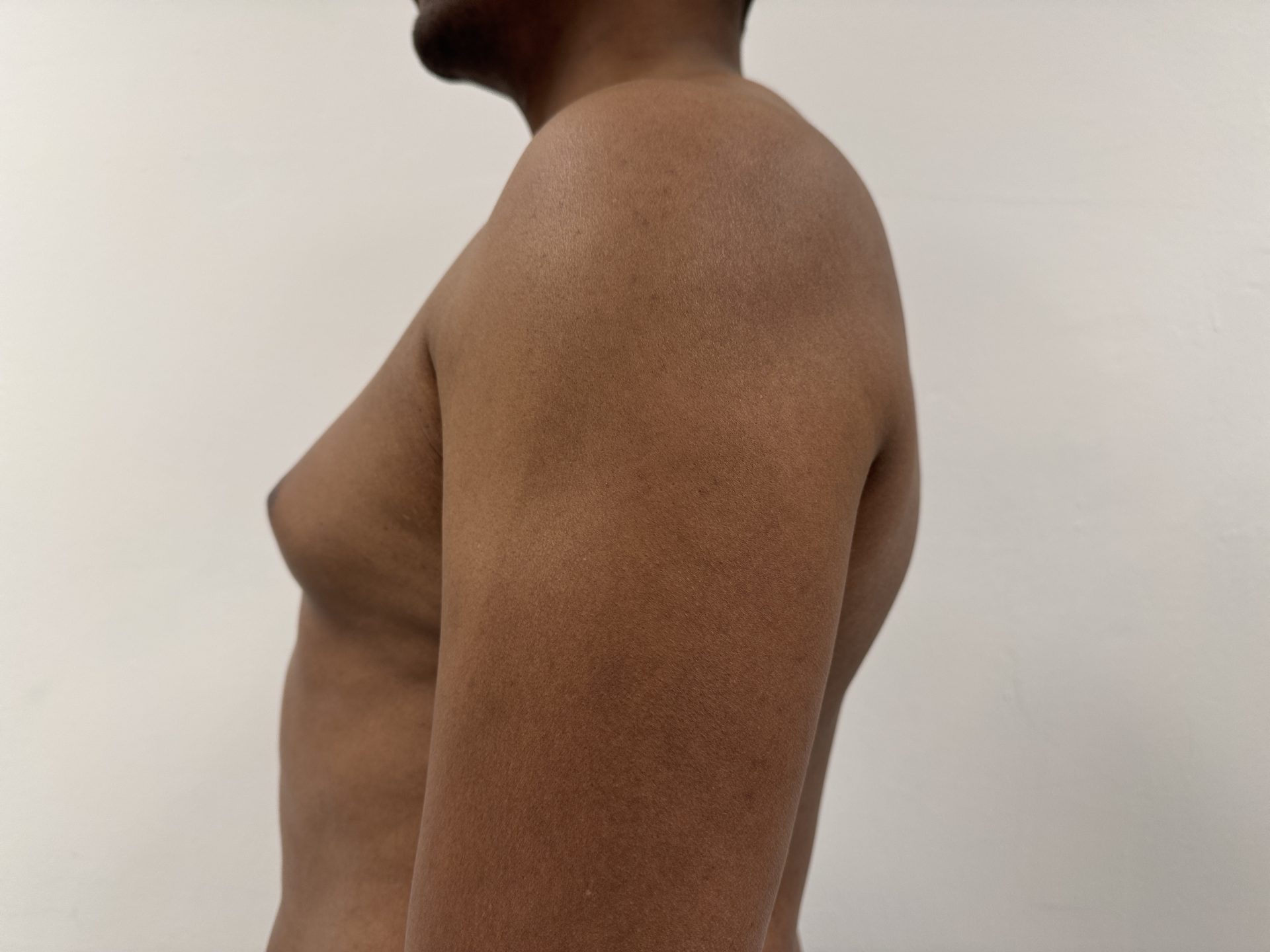 Breast correction for men before