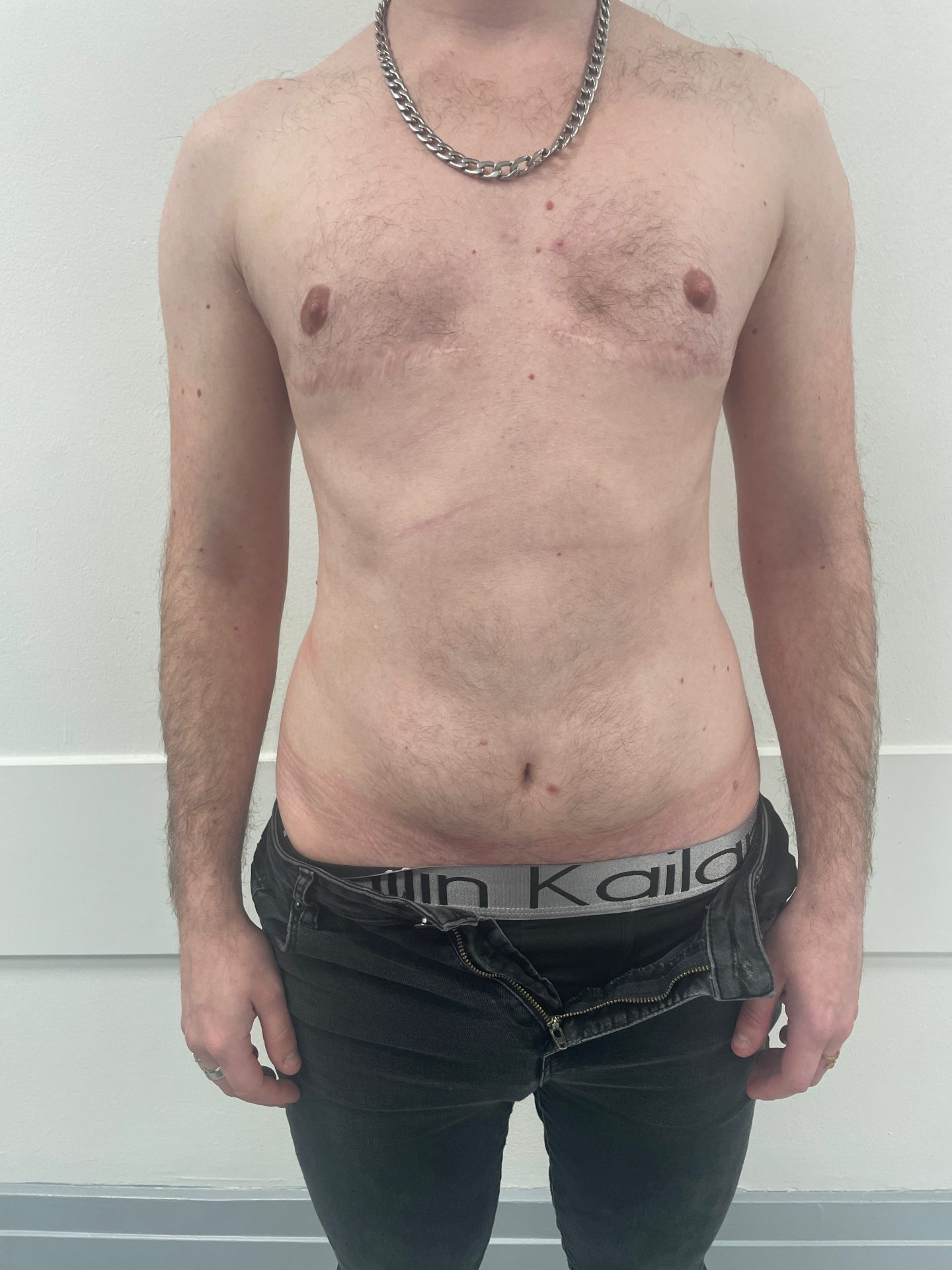 Liposuction before