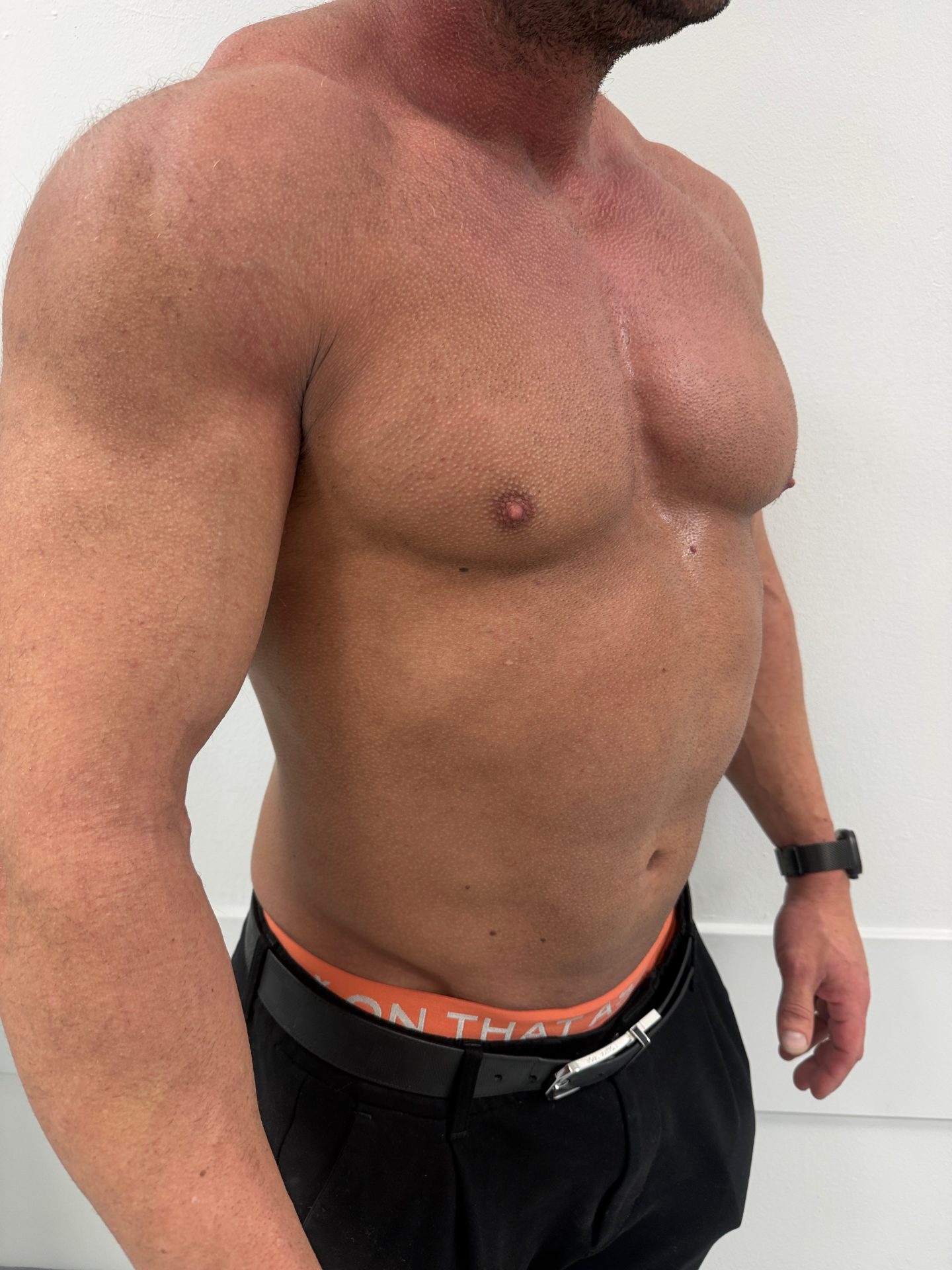 Breast correction for men before
