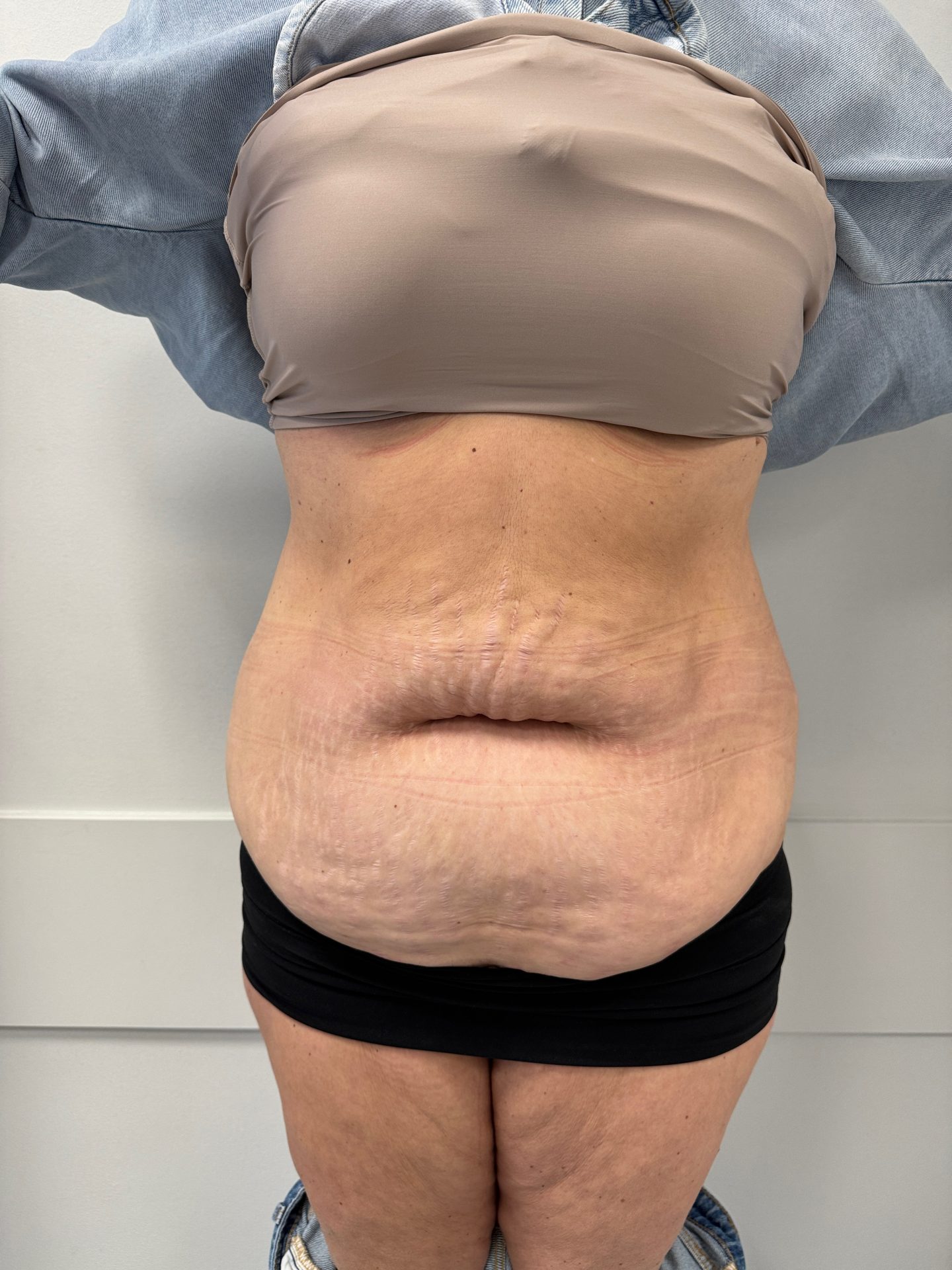 Tummy tuck before