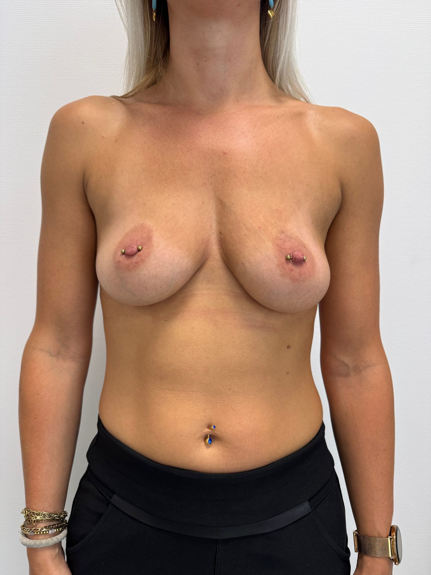 Breast augmentation before