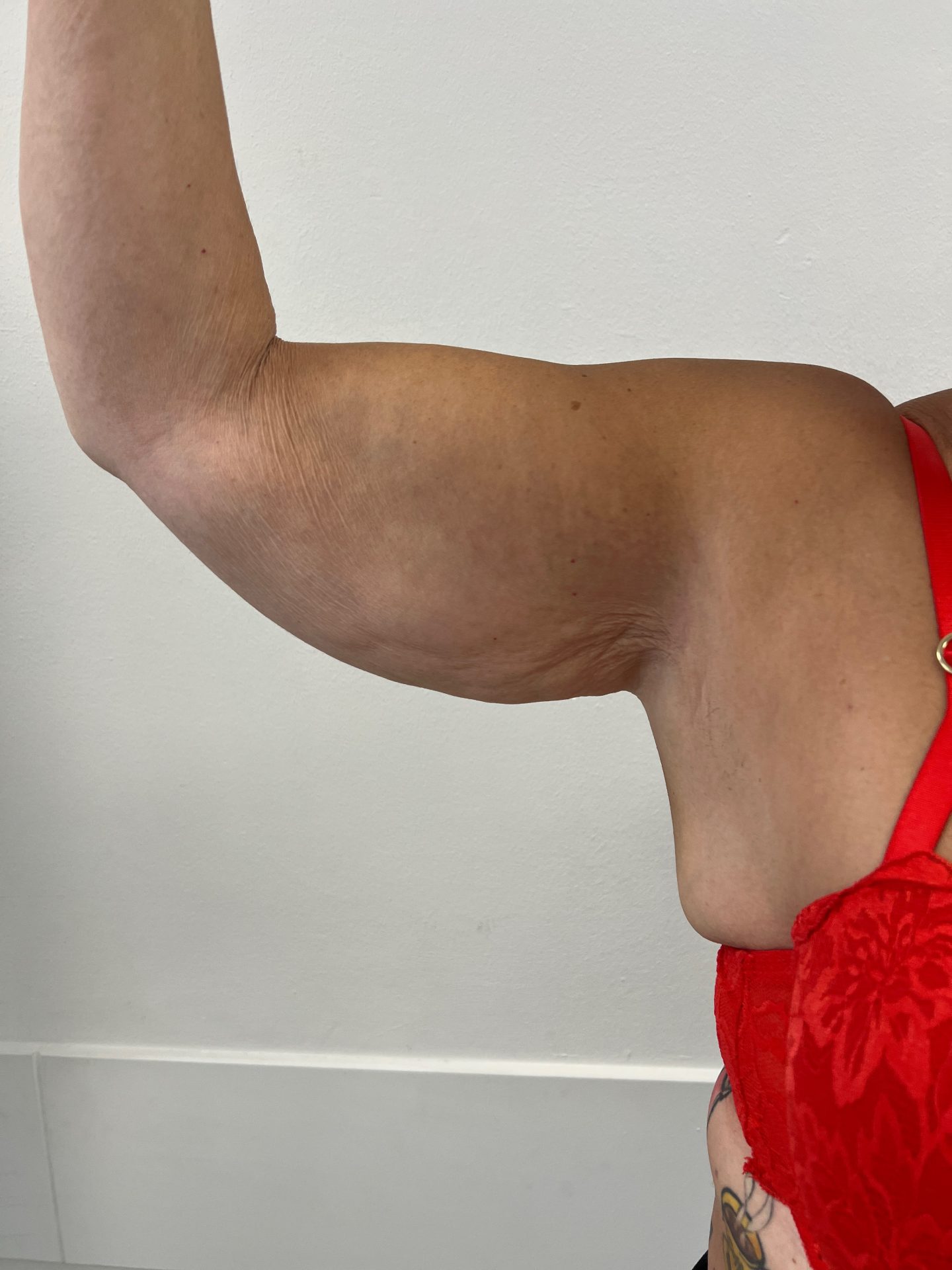 Armlift before