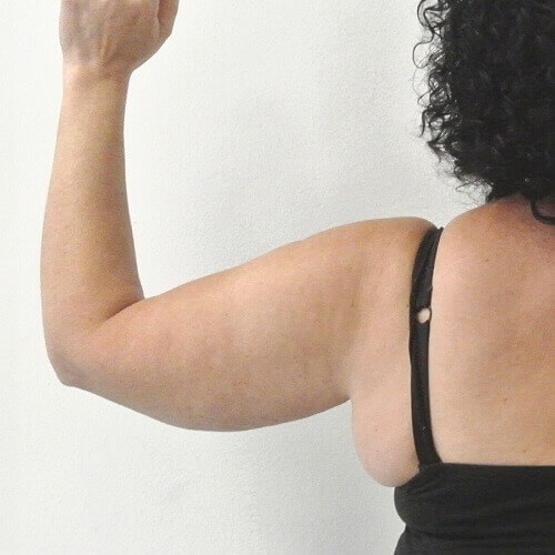 Armlift voor