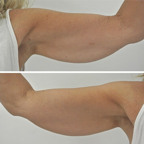 Armlift before