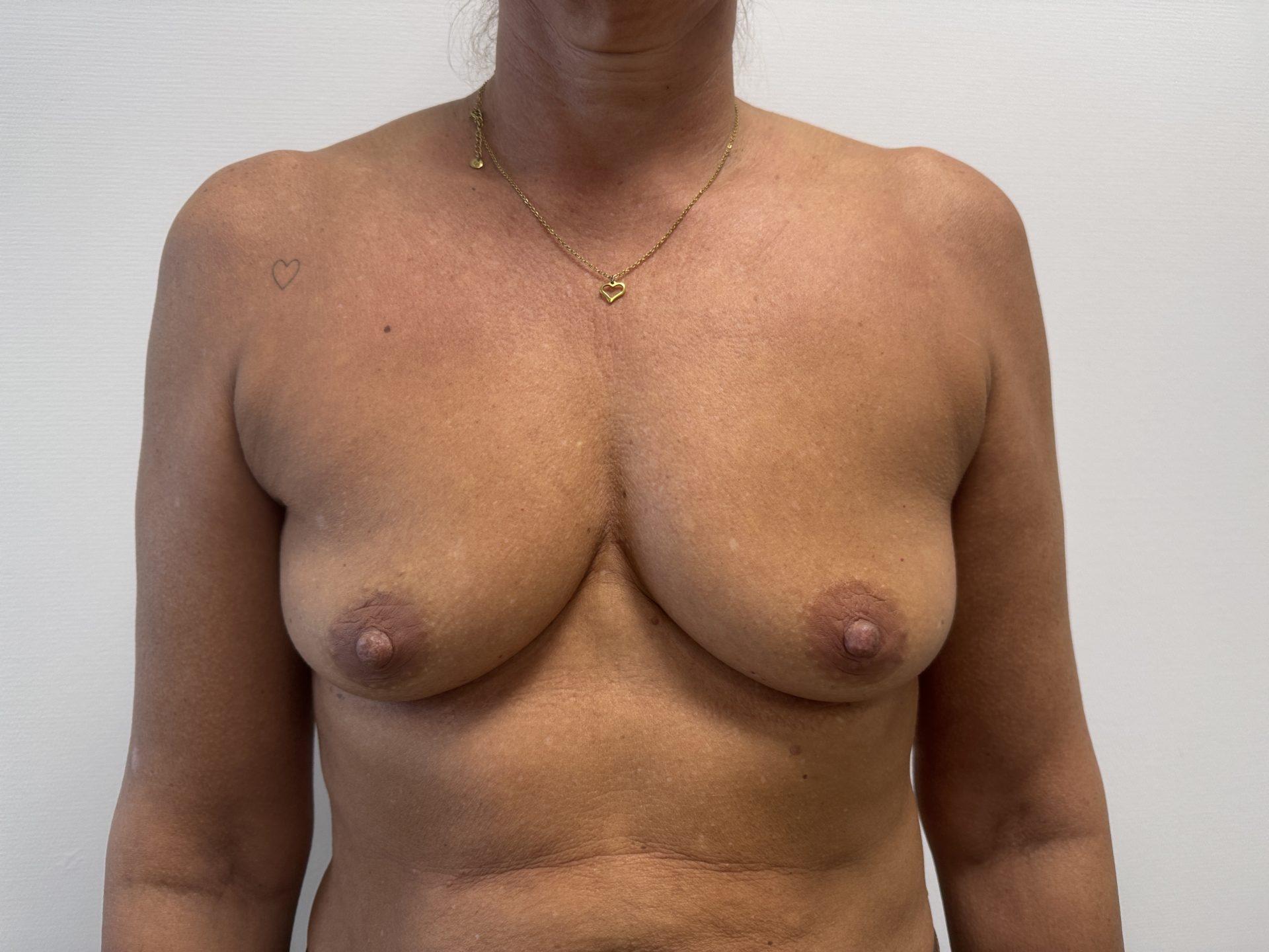 Breast augmentation before