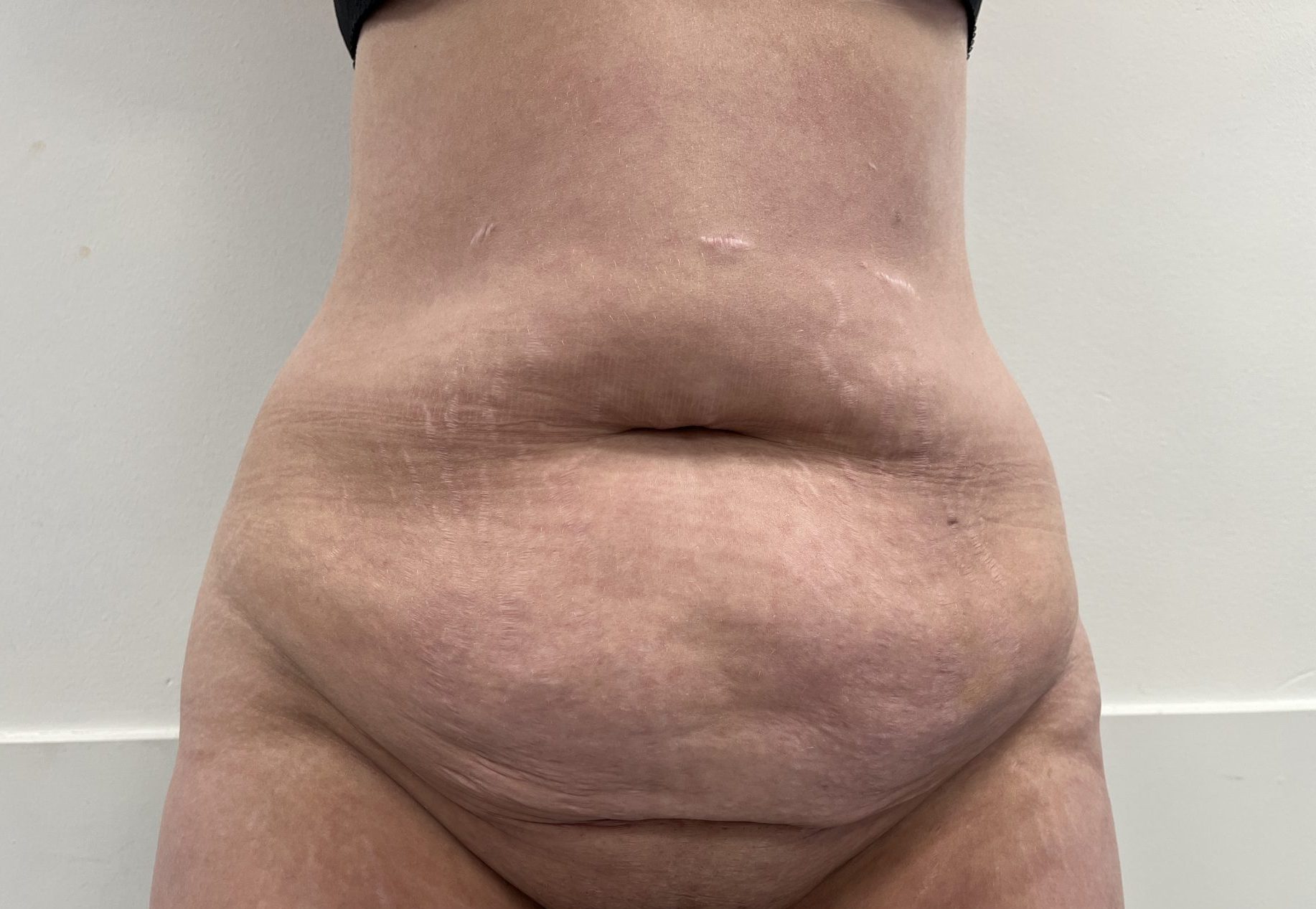 Tummy tuck before