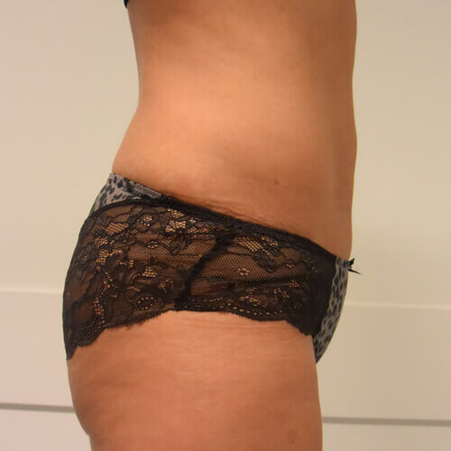 Liposuction after