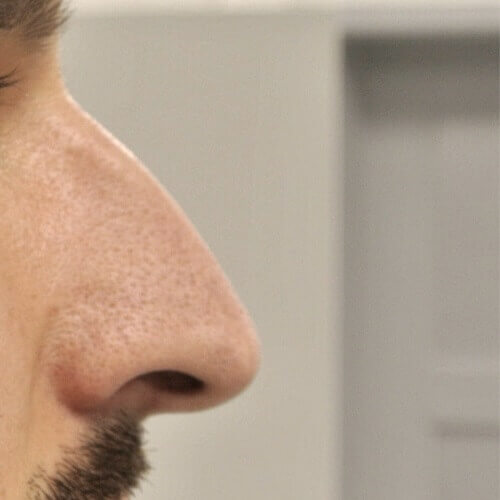 Nose correction before