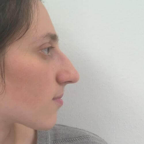 Nose correction before