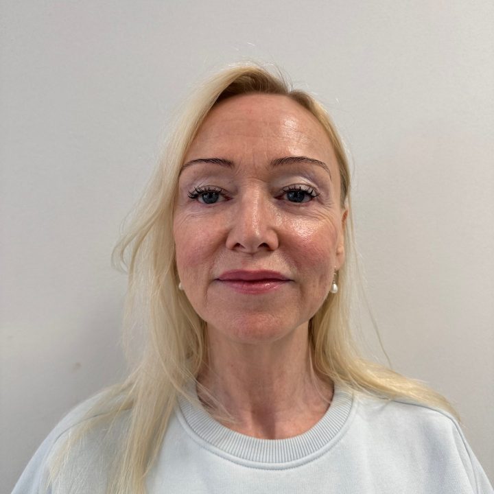 Facelift voor