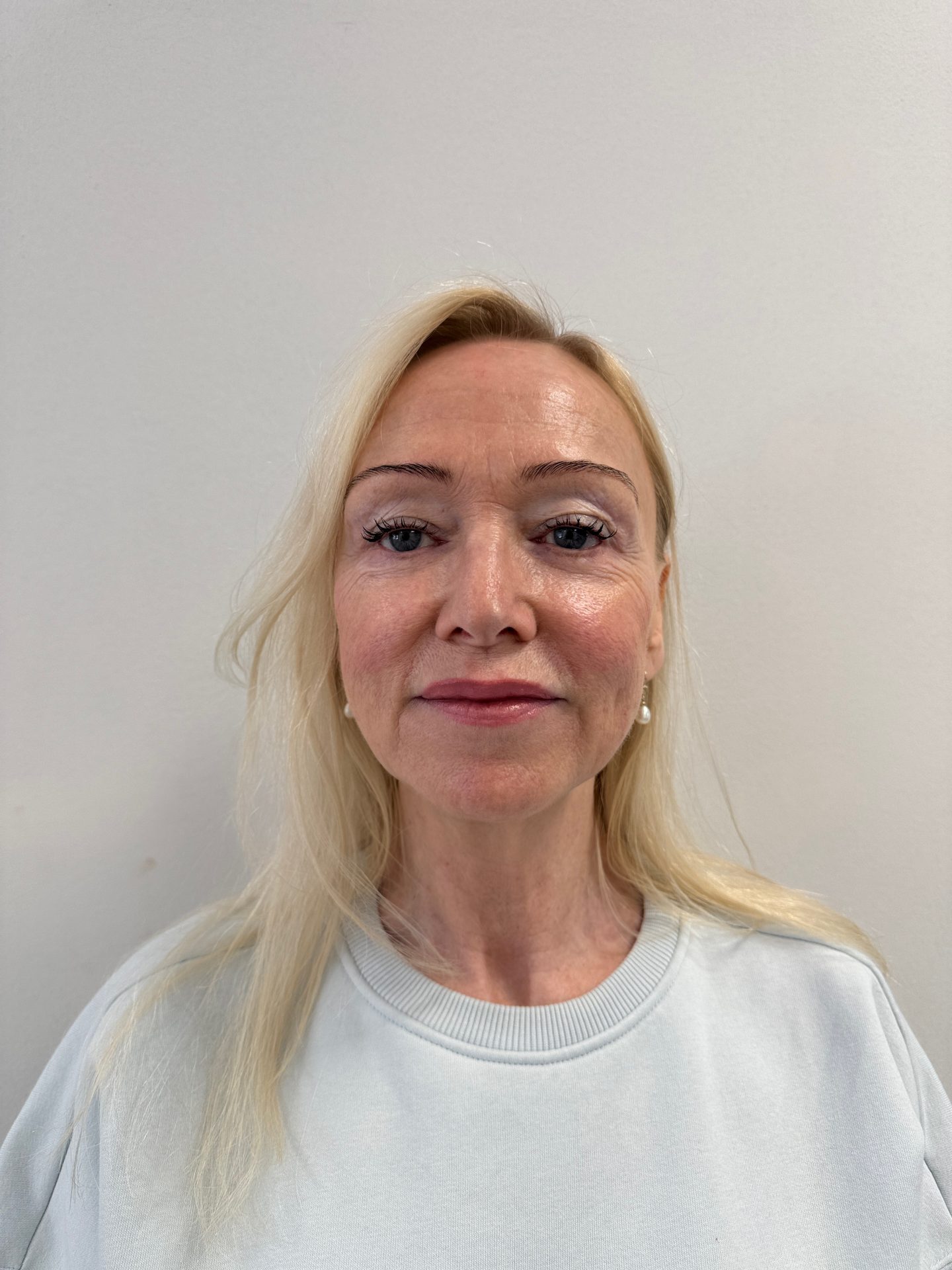 Neck facelift before
