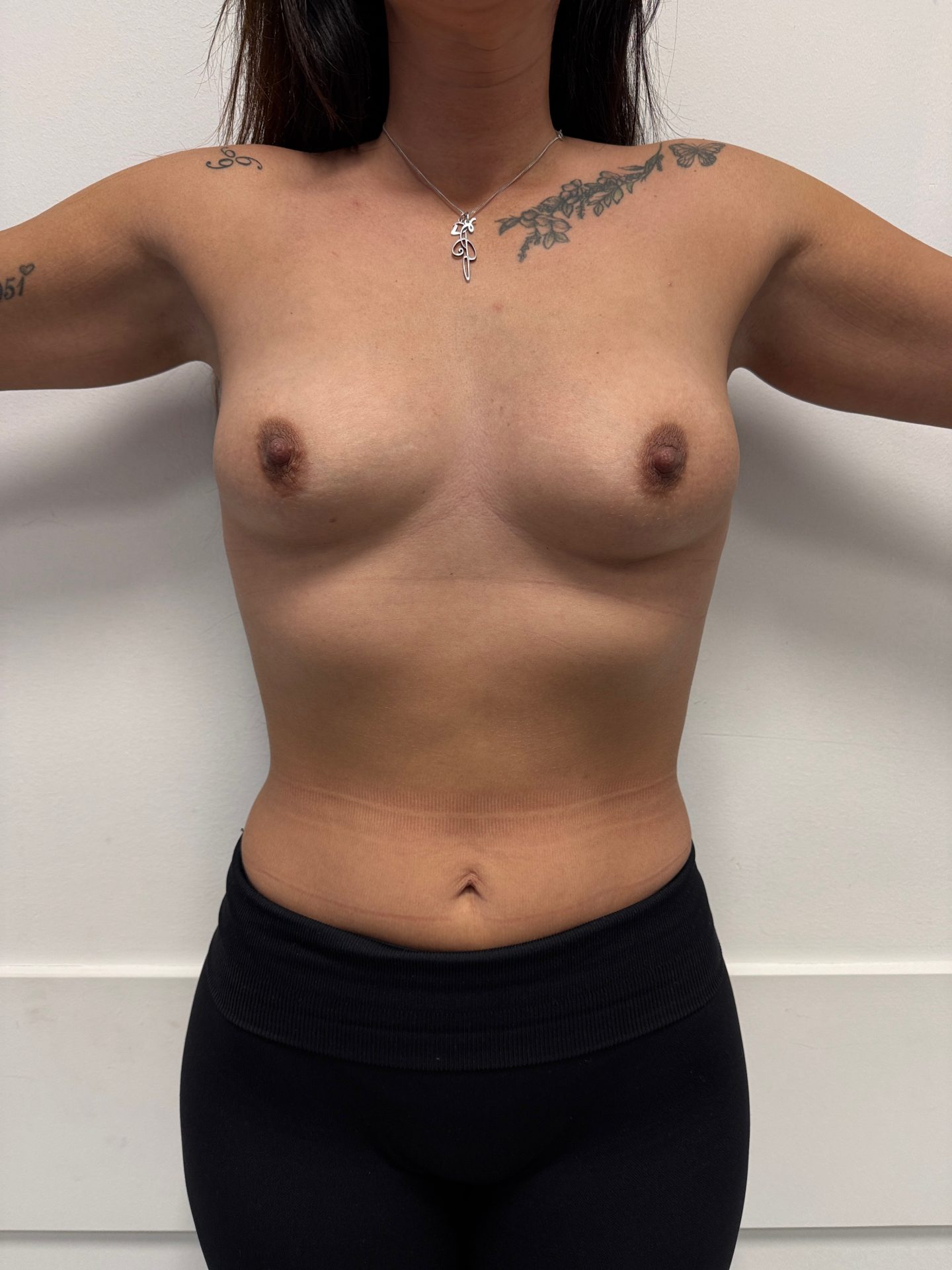 Breast augmentation before