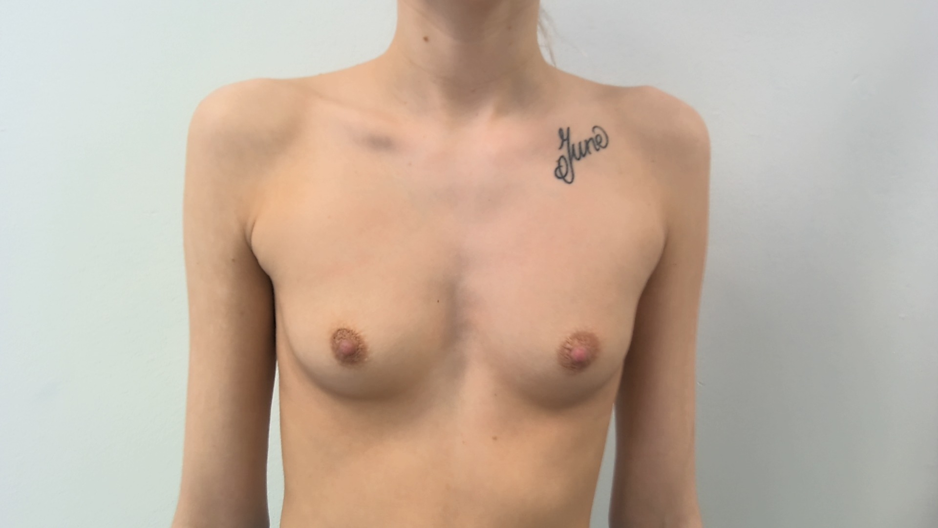 Breast augmentation before