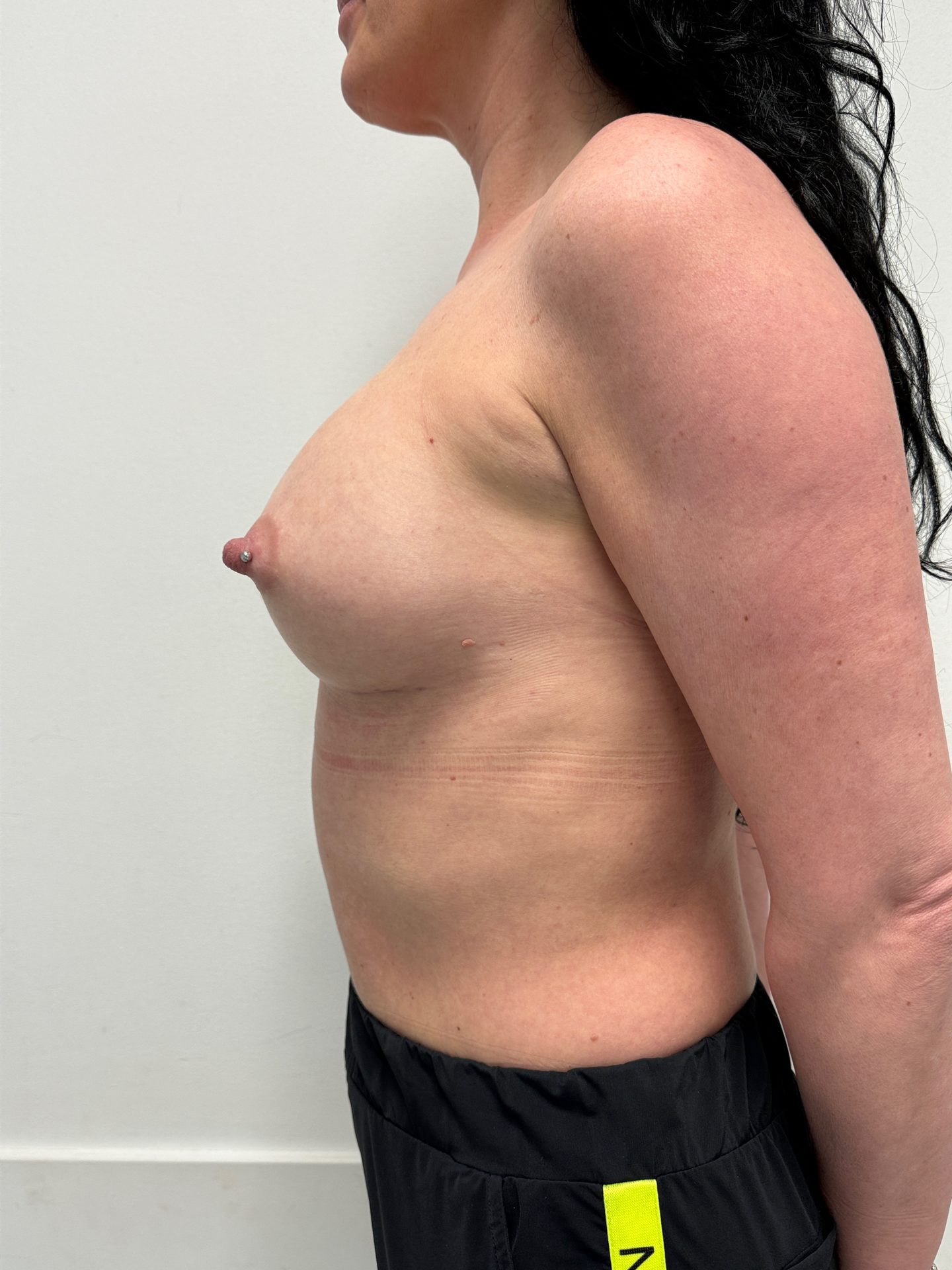 Breast augmentation after