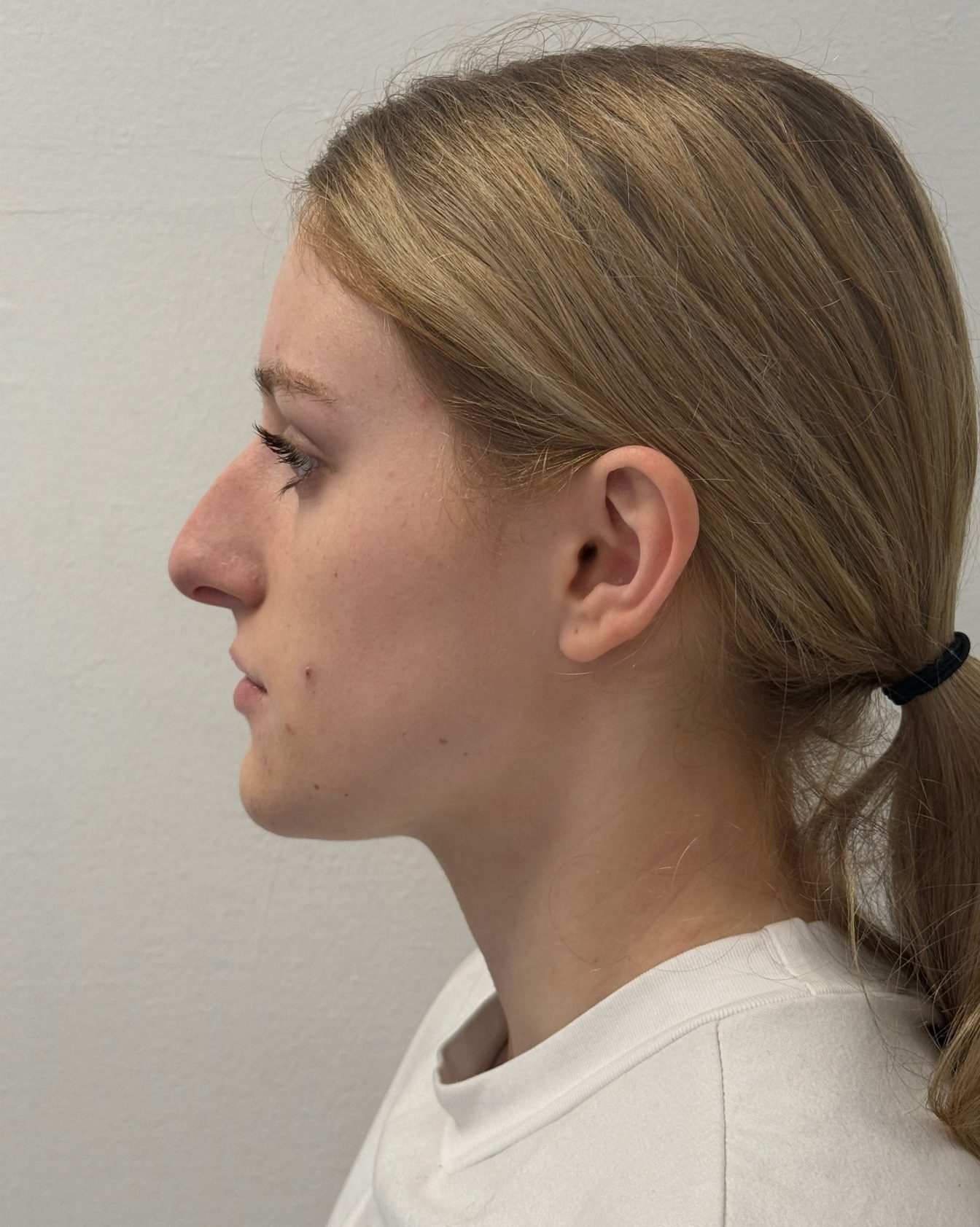 Nose correction before