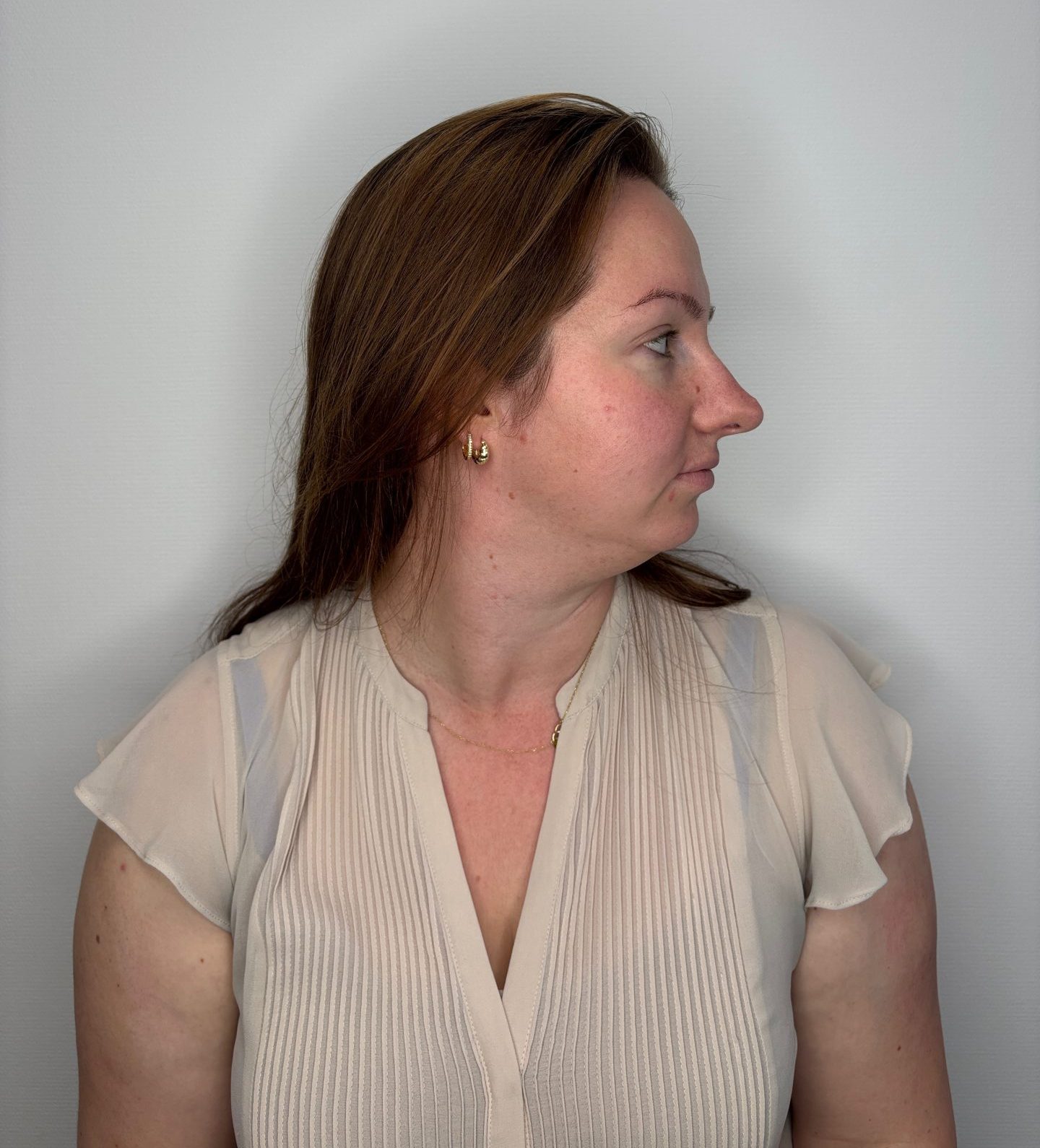 Nose correction before