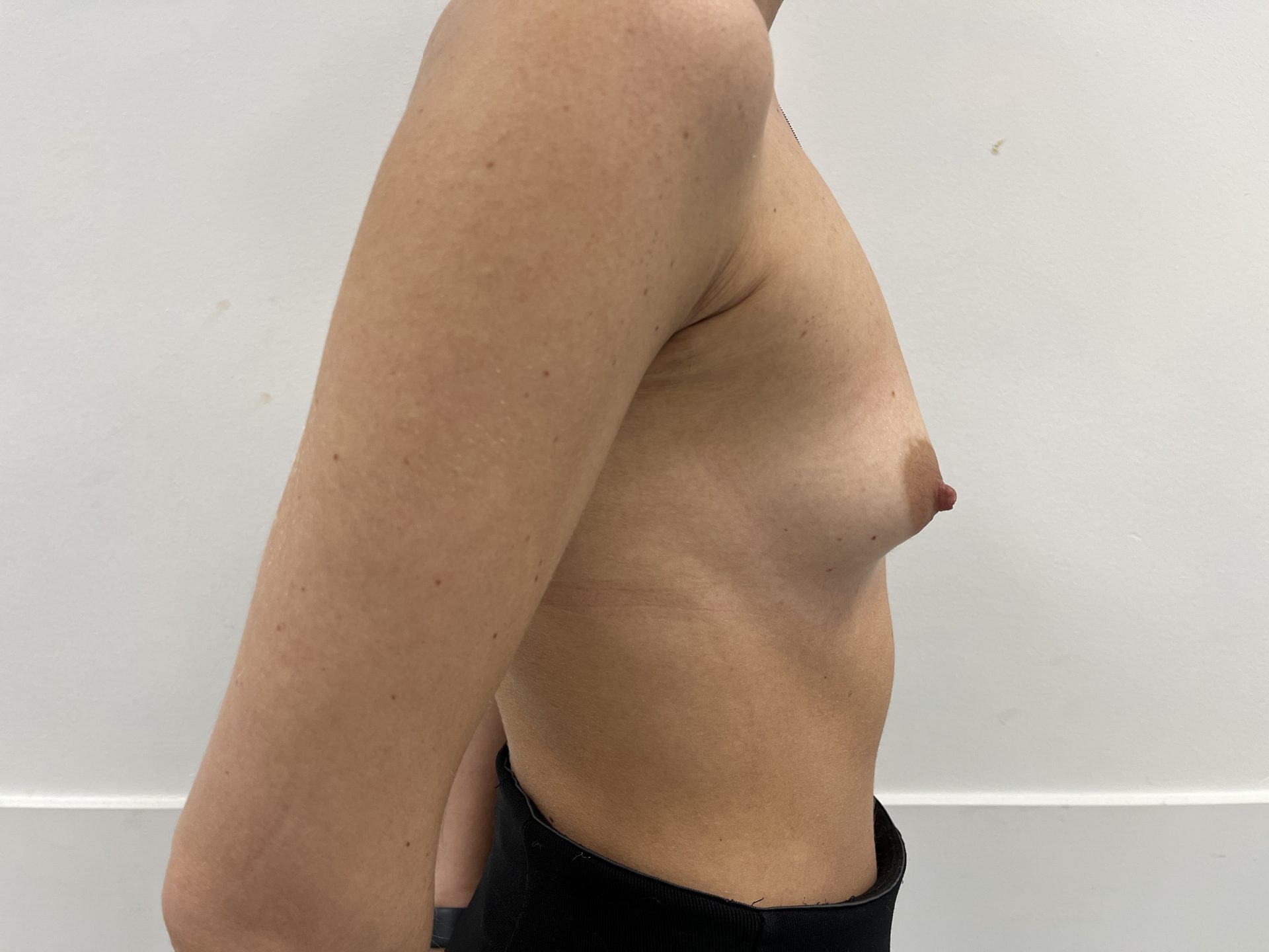 Breast augmentation before