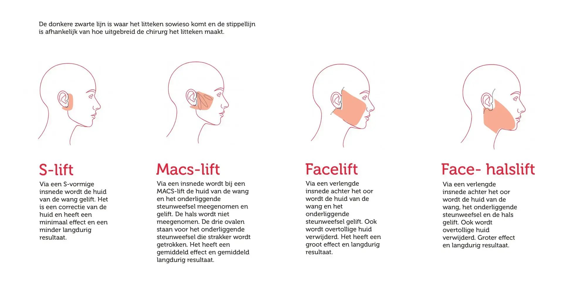 Facelift-varianten-tekening-04-1.jpg-1