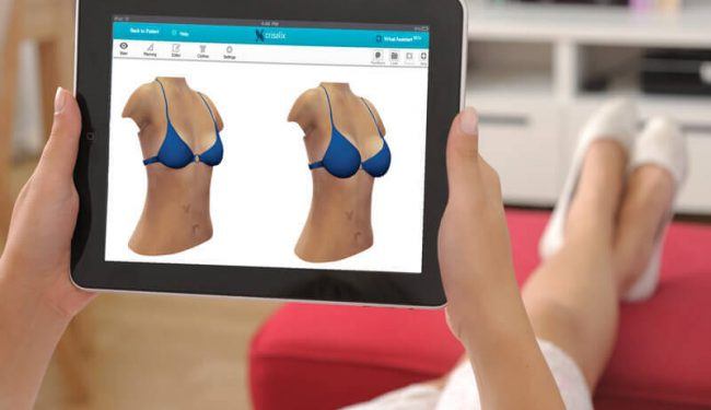 Crisalix 3D-simulatie